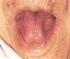 Lengua corta. Medicina China